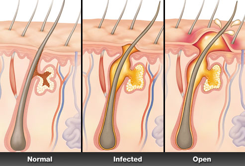 skin  illustration - boil