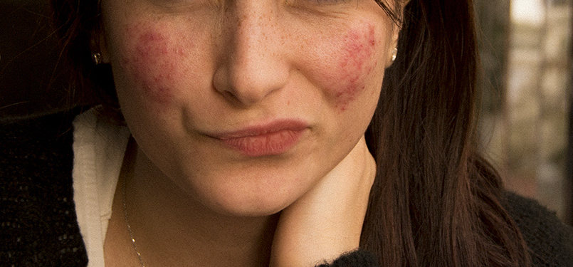 Woman with Rosacea